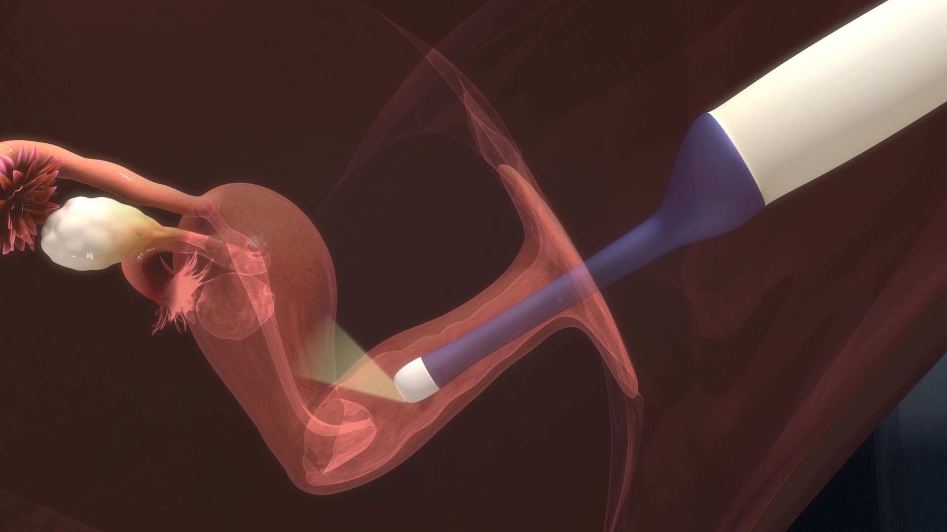 Frozen Embryo Transfer (FET)